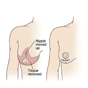 Breastdoctor25